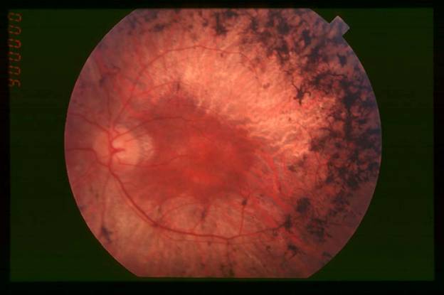 https://upload.wikimedia.org/wikipedia/commons/4/49/Fundus_of_patient_with_retinitis_pigmentosa,_mid_stage.jpg